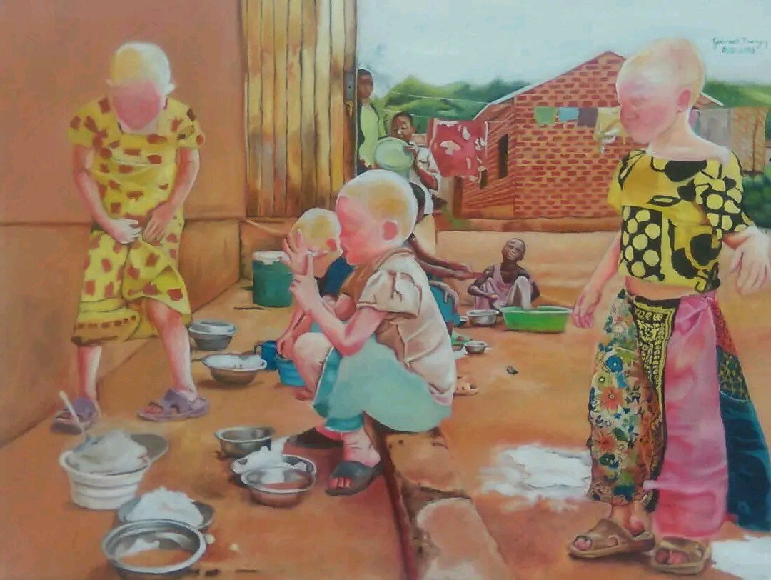 Albinism 